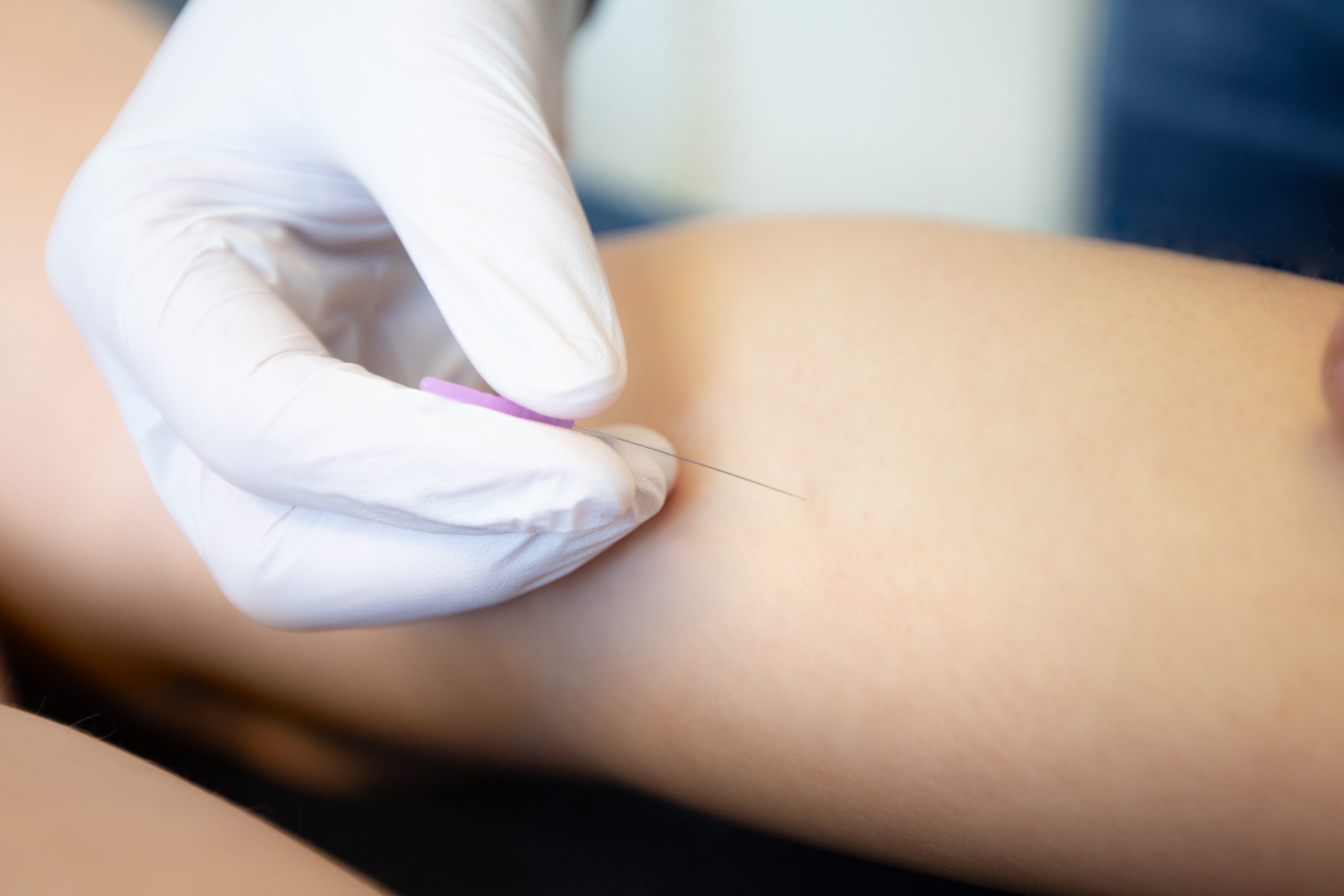 Dry needling
